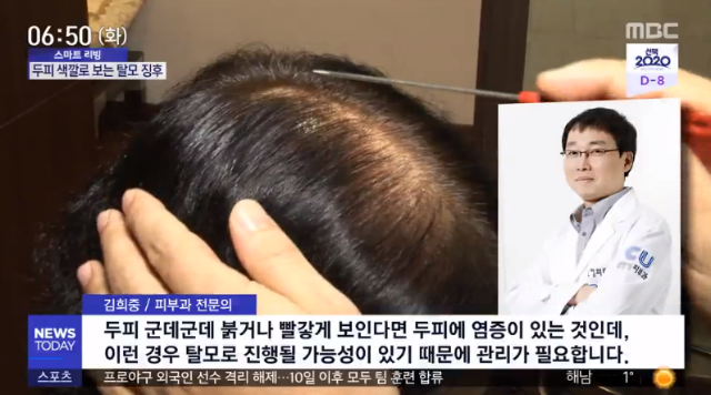 김희중원장_전화인터뷰(두피).PNG